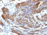 Formalin-fixed, paraffin embedded human uterus sections stained with 100 ul anti-Caldesmon, HMW (clone CALD1/820) at 1:50. HIER epitope retrieval prior to staining was performed in 10mM Tris 1mM EDTA, pH 9.0.